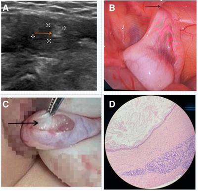 Testicular tumor arising from an intra-abdominal undescended testis in a 1-year-old child: a case report and literature review